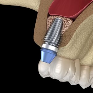 Osspore Sinus-implant bone