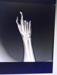 Finger implant
