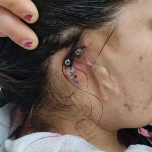 Alternative view of Ear implant