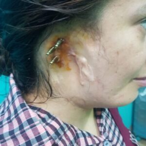 Ear implant