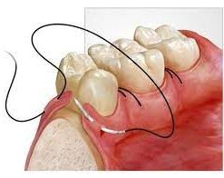 medical-sutures