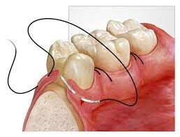 medical-sutures