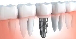 Solo implant