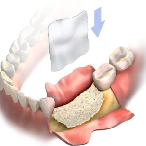 OSSPORE Collagen membrane
