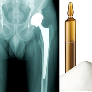OSSCHEM G bone cement