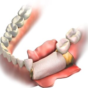 OSSPORE Titanium Membrane